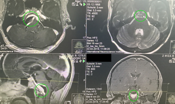 較大巖斜區(qū)腦膜瘤全切案例