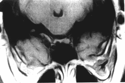 聽神經(jīng)瘤治療
