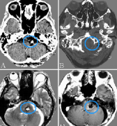 較大腦動脈瘤能順利手術(shù)嗎？