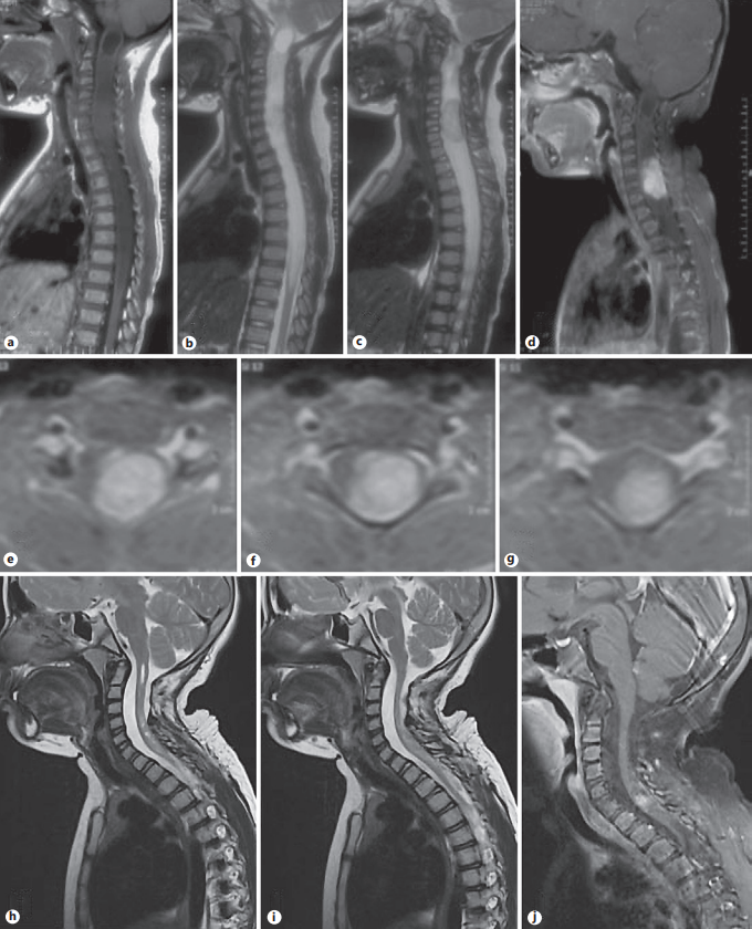 脊髓膠質(zhì)瘤能治好嗎？三臺(tái)脊髓膠質(zhì)瘤手術(shù)案例剖析