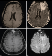 額葉少枝膠質瘤怎么治？少枝膠質瘤二級嚴重嗎？