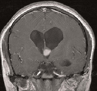 位于三腦室的神經(jīng)節(jié)細(xì)胞膠質(zhì)瘤能通過(guò)手術(shù)切除嗎？