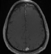 矢狀竇腦膜瘤108例手術(shù)研究報(bào)告