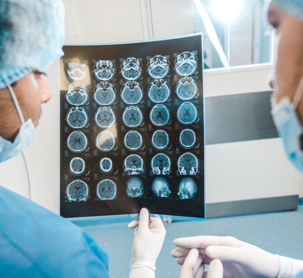 兒童視神經(jīng)膠質(zhì)瘤該如何治療才能保住視力？