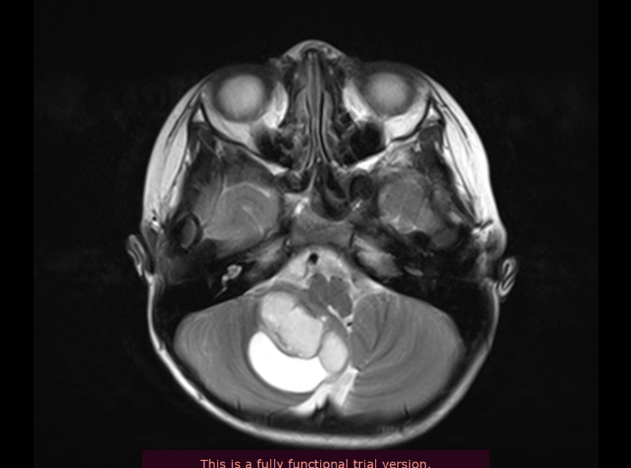 較大膠質(zhì)瘤壓迫腦干如何長(zhǎng)期生存？7歲男孩赴德治療膠質(zhì)瘤終獲順利全切