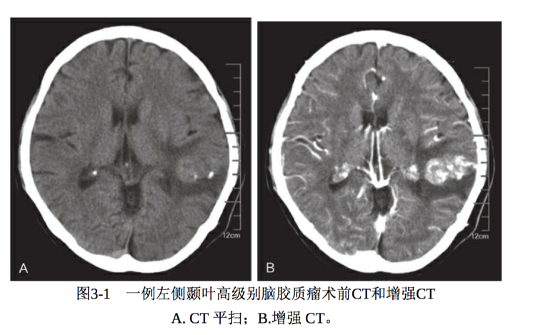 高級別腦膠質(zhì)瘤