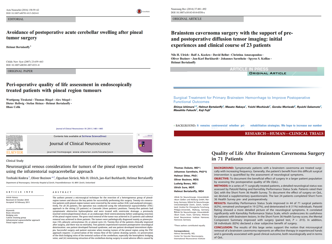 巴特朗菲教授——什么人更容易得腦瘤？