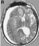 三叉神經(jīng)周圍動靜脈畸形案例解讀：手術(shù)還是放療？