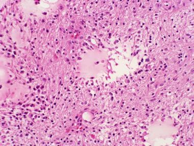 毛細胞星形細胞瘤預后如何？