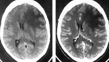 星形<a href='/bingzhong/jiaozhiliu/' target='_blank'><u>膠質(zhì)瘤</u></a>