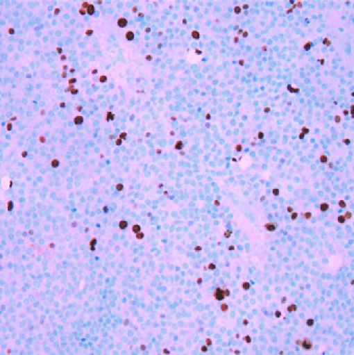 垂體腺瘤復(fù)發(fā)，和Ki-67指數(shù)有關(guān)？