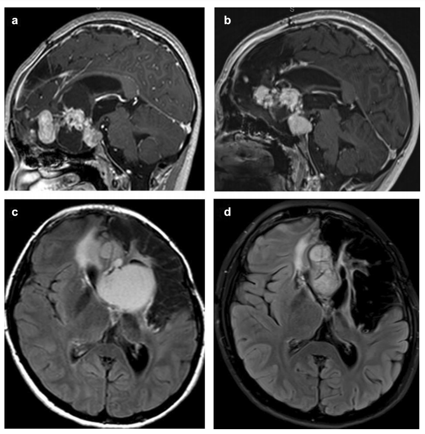 曲美替尼治療進(jìn)展性兒童低級別膠質(zhì)瘤：毛細(xì)胞星形細(xì)胞瘤