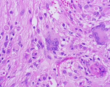 多形性黃色星形細(xì)胞瘤