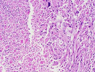 多形性黃色星形細(xì)胞瘤