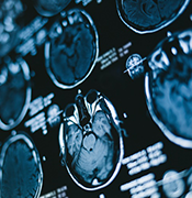 低級別膠質(zhì)瘤能自愈嗎？