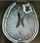 額葉膠質瘤手術是什么樣的？全程簡述