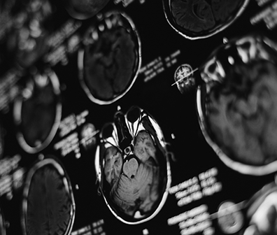 聽神經(jīng)瘤術(shù)后并發(fā)癥有哪些？面癱及聽力損失可以避免嗎？