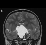 顱咽管瘤復(fù)發(fā)了有什么治療手段？