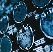 聽神經(jīng)瘤手術(shù)后容易復發(fā)嗎？