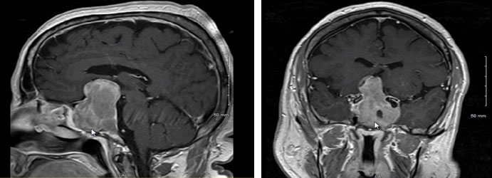 垂體瘤需要手術(shù)嗎？