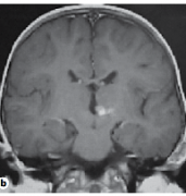 丘腦膠質瘤能治好嗎？丘腦膠質瘤的手術治療關鍵點