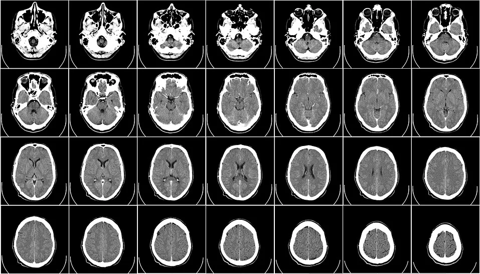 小兒膠質(zhì)瘤