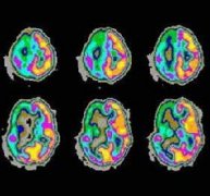 小兒癲癇發(fā)作前有什么征兆？怎么控制？