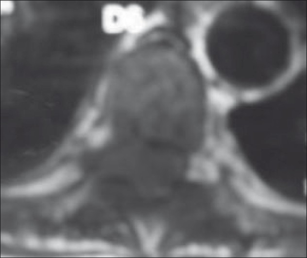 61歲脊髓背側(cè)硬膜外海綿狀血管瘤