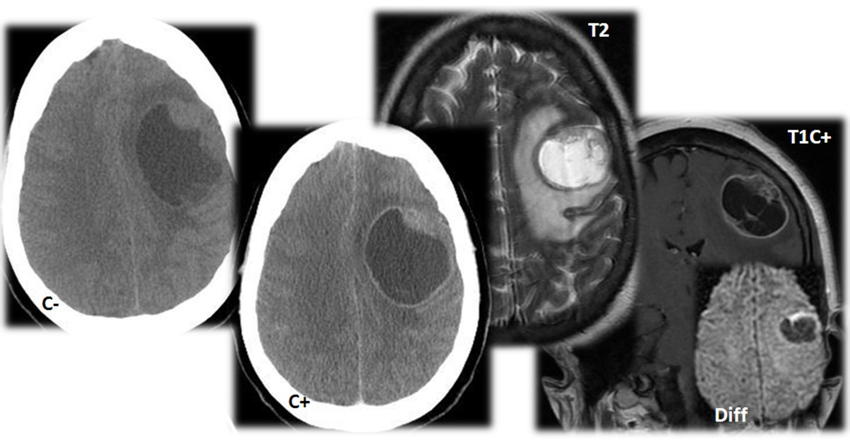 額葉膠質瘤開顱手術后遺癥