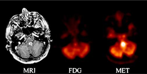 間變膠質(zhì)瘤