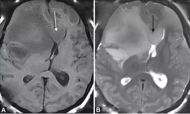 胼胝體膠質瘤臨床癥狀和生存期,什么是胼胝體膠質瘤？