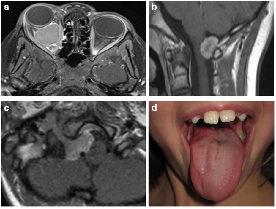 小兒2型神經(jīng)纖維瘤（NF2）患者的癥狀表現(xiàn)
