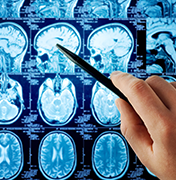 膠質(zhì)瘤誤診情況多嗎？如何確診？