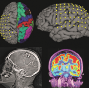 良性癲癇多久發(fā)作一次？