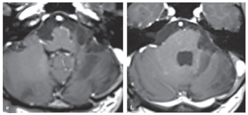 腦干膠質(zhì)母細(xì)胞瘤影像