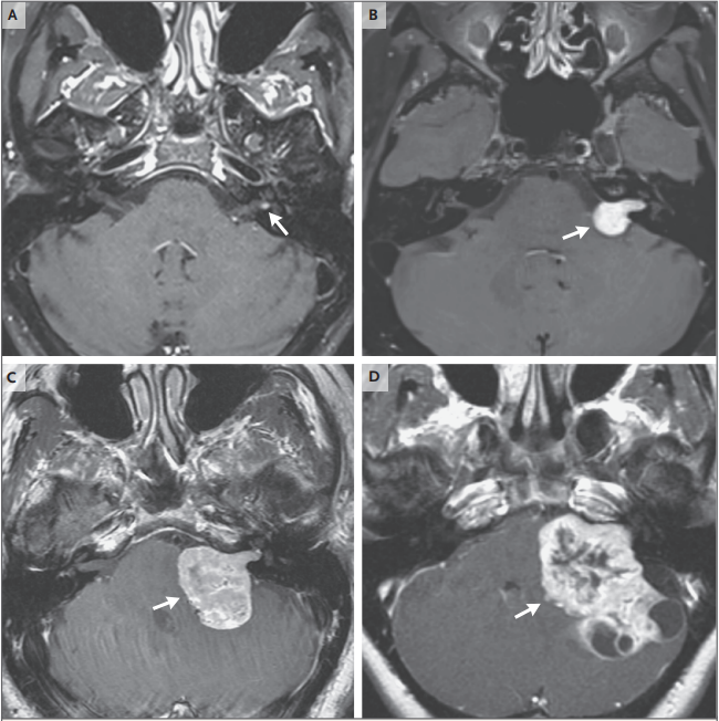 問：聽神經(jīng)瘤的早期癥狀有哪些？