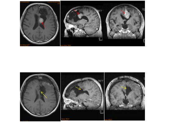 矢狀竇旁腦膜瘤