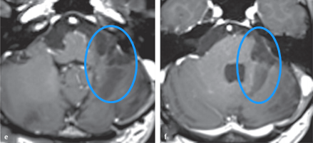 腦干膠質(zhì)母細(xì)胞瘤