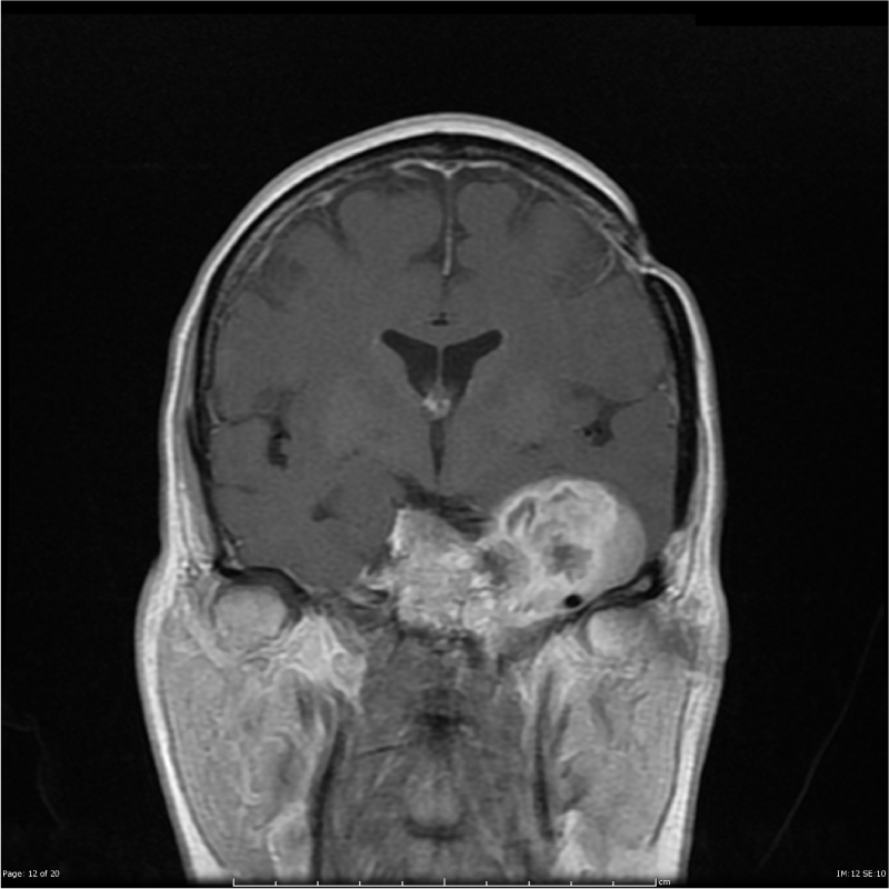 軟骨肉瘤和脊索瘤是不是一樣的病？