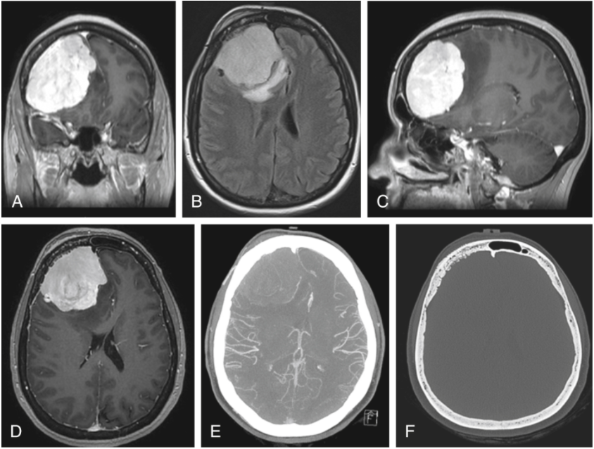 惡心、腹瀉、頭痛，1級(jí)腦膜瘤患者全切治療記錄
