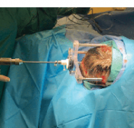 LITT激光間質(zhì)熱療：藥物難治性癲癇的微創(chuàng)手術(shù)選擇