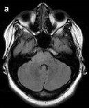 高級(jí)別膠質(zhì)瘤是什么？有什么治療選擇？