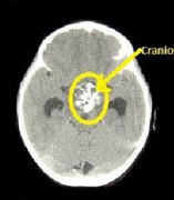 顱咽管瘤全切幾率多大？