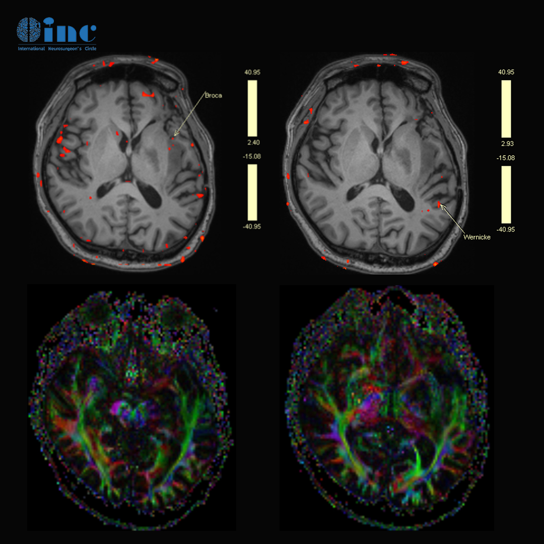 功能區(qū)膠質(zhì)瘤手術(shù)案例(質(zhì)子治療)