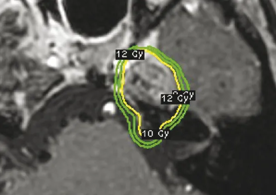 脊索瘤的放射治療效果怎么樣？