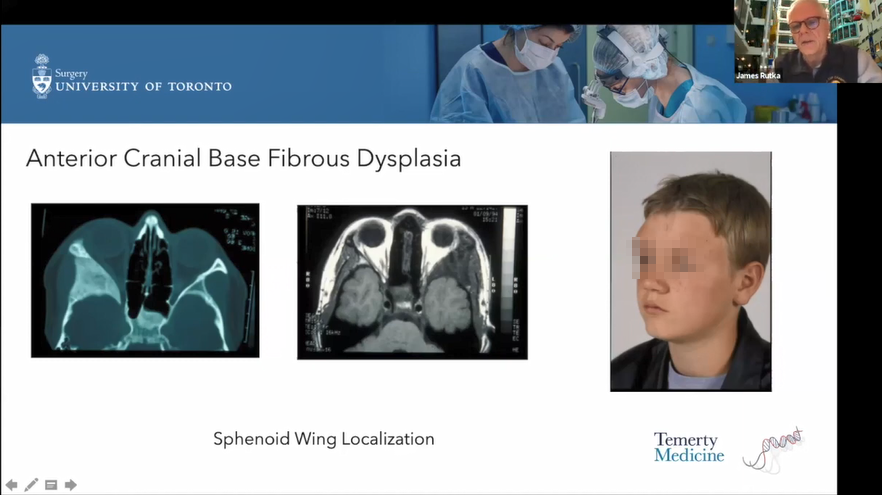 兒童前顱底瘤種、癥狀、診斷方法及手術(shù)