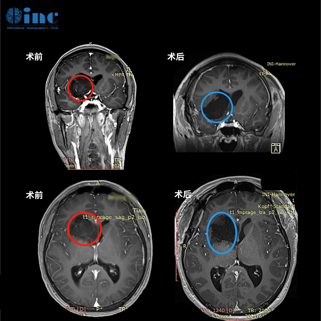 基底節(jié)膠質(zhì)瘤案例