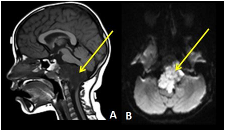 腦干腫瘤能活多久