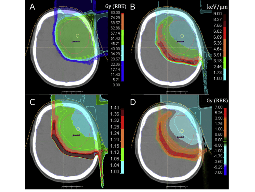 腦瘤術(shù)后放療理想選擇——質(zhì)子治療