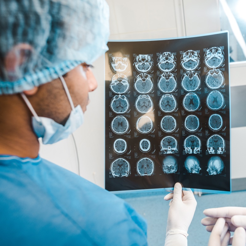 神經(jīng)膠質(zhì)瘤患者臨床預(yù)后判斷miRNA-21的意義。